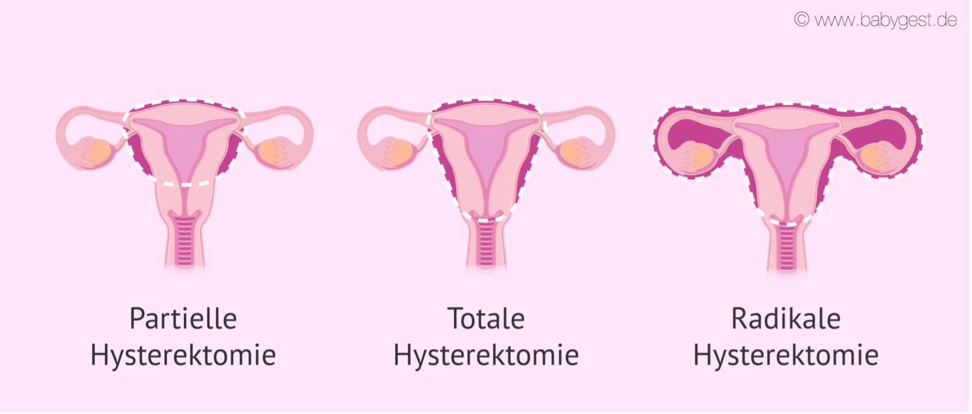 adenomyose-endometriose