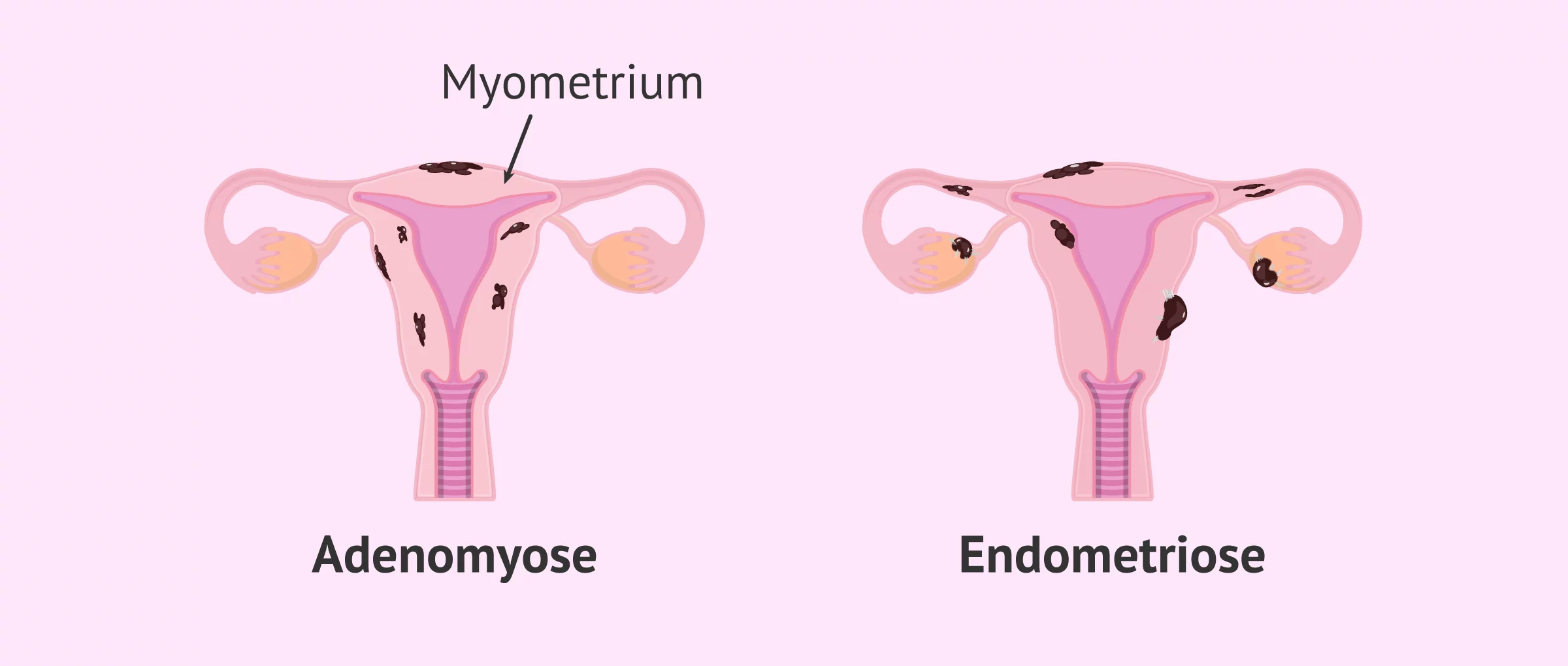 adenomyose-endometriose.png